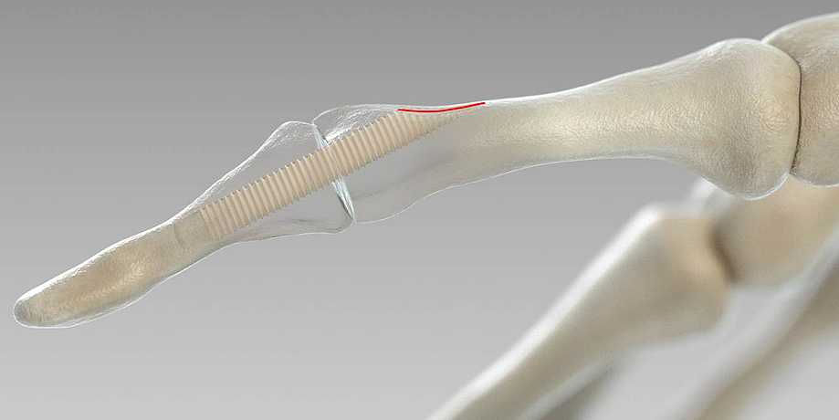 Austrian Scientists Turn Human Bone into Surgical Screws